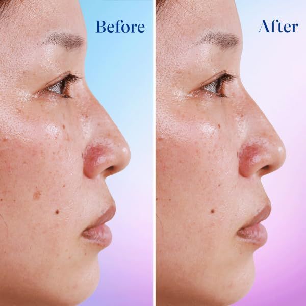 Differin Dark Spot Correcting Face Serum, Dark Spot Correcting Serum by the makers of Differin Gel, Gentle Skin Care for Acne Prone Sensitive Skin, 1 oz (Packaging May Vary) - USA in UK