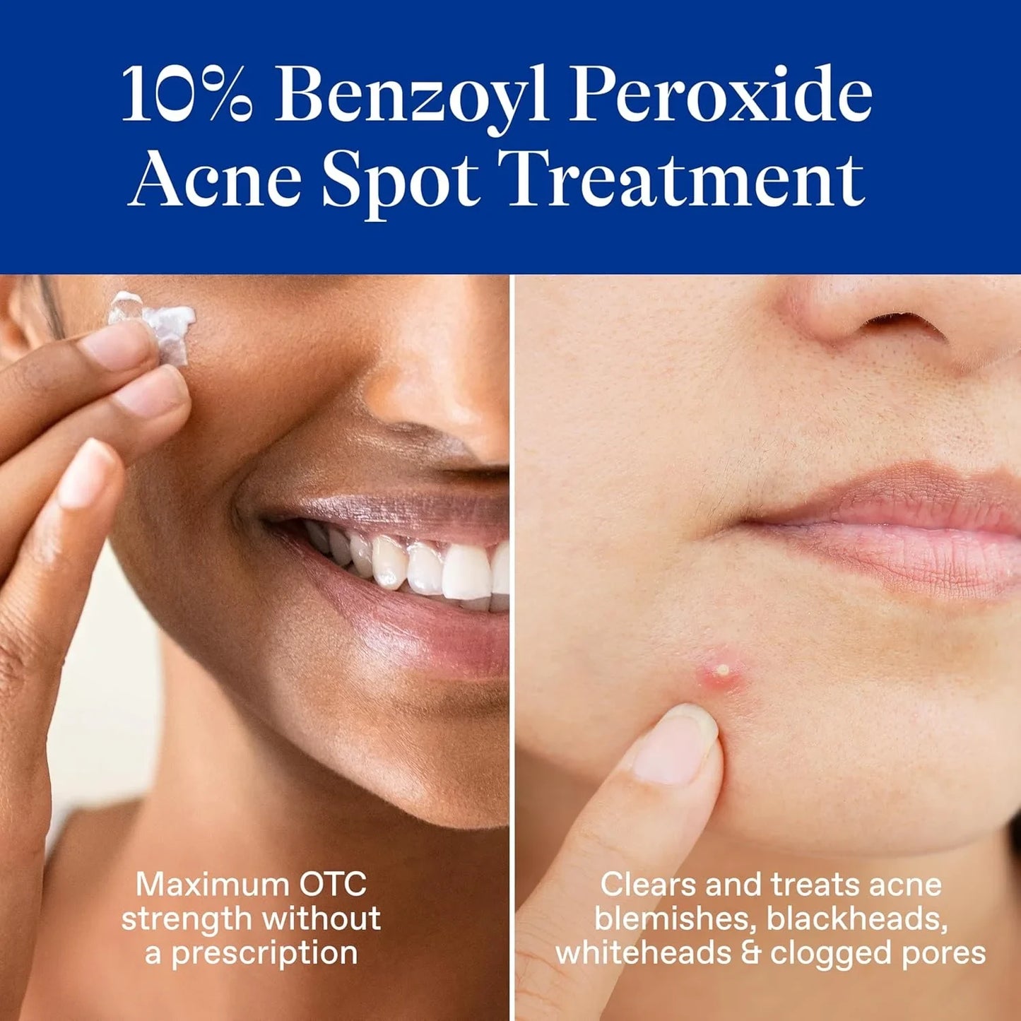 Differin Acne Spot Treatment with 10% Benzoyl Peroxide, Maximum Strength OTC Acne Treatment, Fast Acting Spot Treatment for Face, 1 Oz - USA in UK