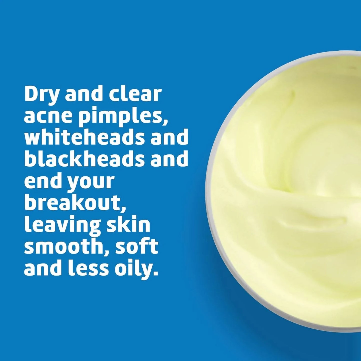 De La Cruz, Acne Treatment Ointment with 10% Sulfur, Maximum Strength, 5.5 oz - USA in UK
