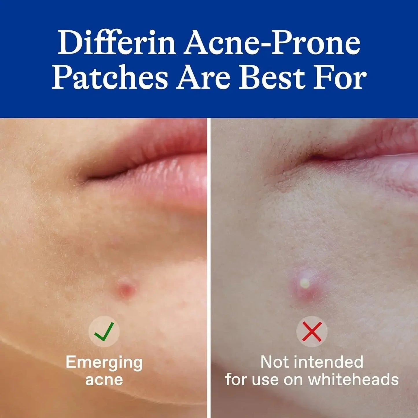 Differin Acne Patches, Pimple Patches for Acne Prone Skin, Formulated with Salicylic Acid and Centella, Fast Triple Action Power Patch for Day & Night, Dermatologist Tested, 36 Count - USA in UK