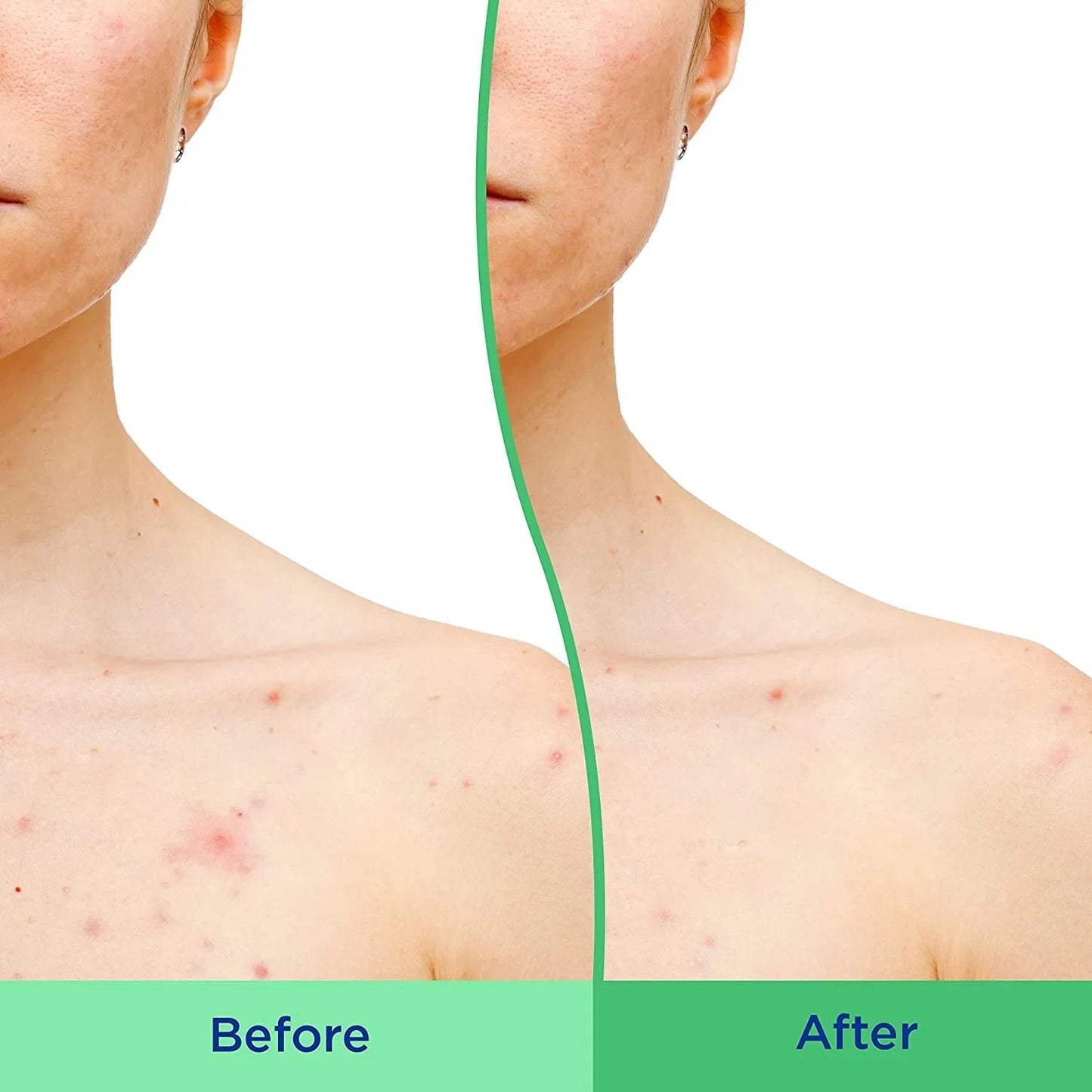 Differin Body Scrub with Salicylic Acid Acne Clearing Improves Tone and Texture Prone Skin on Back Shoulders and Chest, 8 Oz (Packaging May Vary) - USA in UK