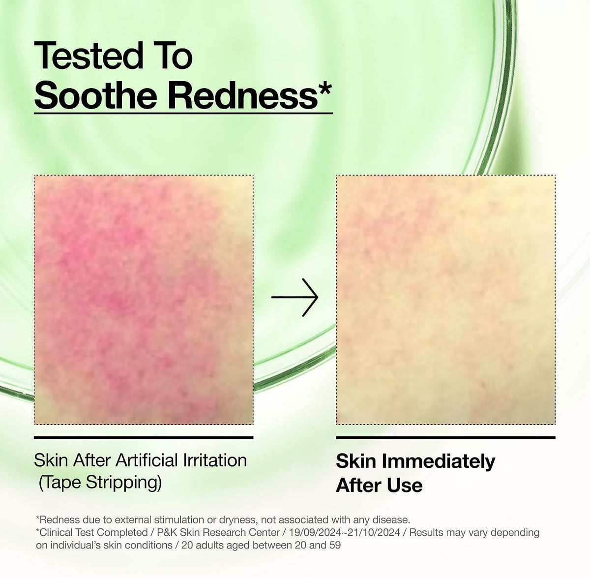 Anua Soothing and Barrier Support Duo, Azelaic Acid Serum and Ceramide Cream — alternate product view