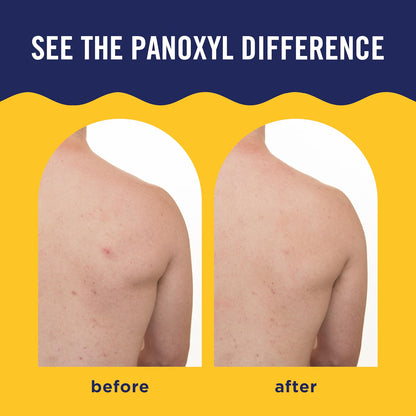 PanOxyl Acne Banishing Body Spray 2% Salicylic Acid 6 oz (170 g)
