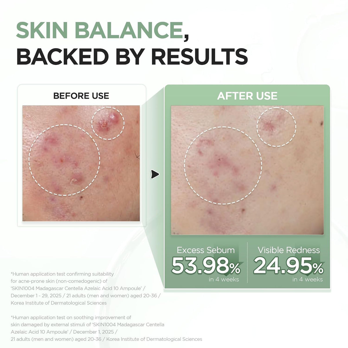 SKIN1004 Azelaic Acid 10% Ampoule, Centella Serum, 1.01 fl oz (30 ml) - view 5