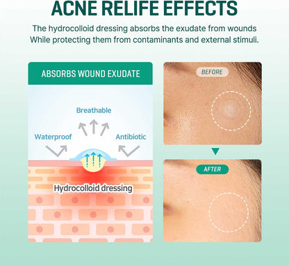 SOME BY MI 30 Days Miracle Clear Spot Patch - 18 Patches in 2 Sizes - view 5