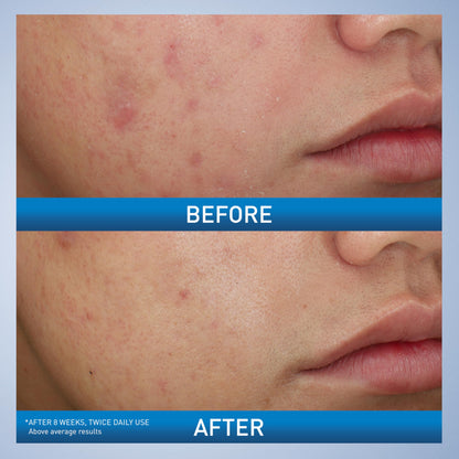 CeraVe 10% benzoyl peroxide wash before and after 8 weeks of twice-daily use