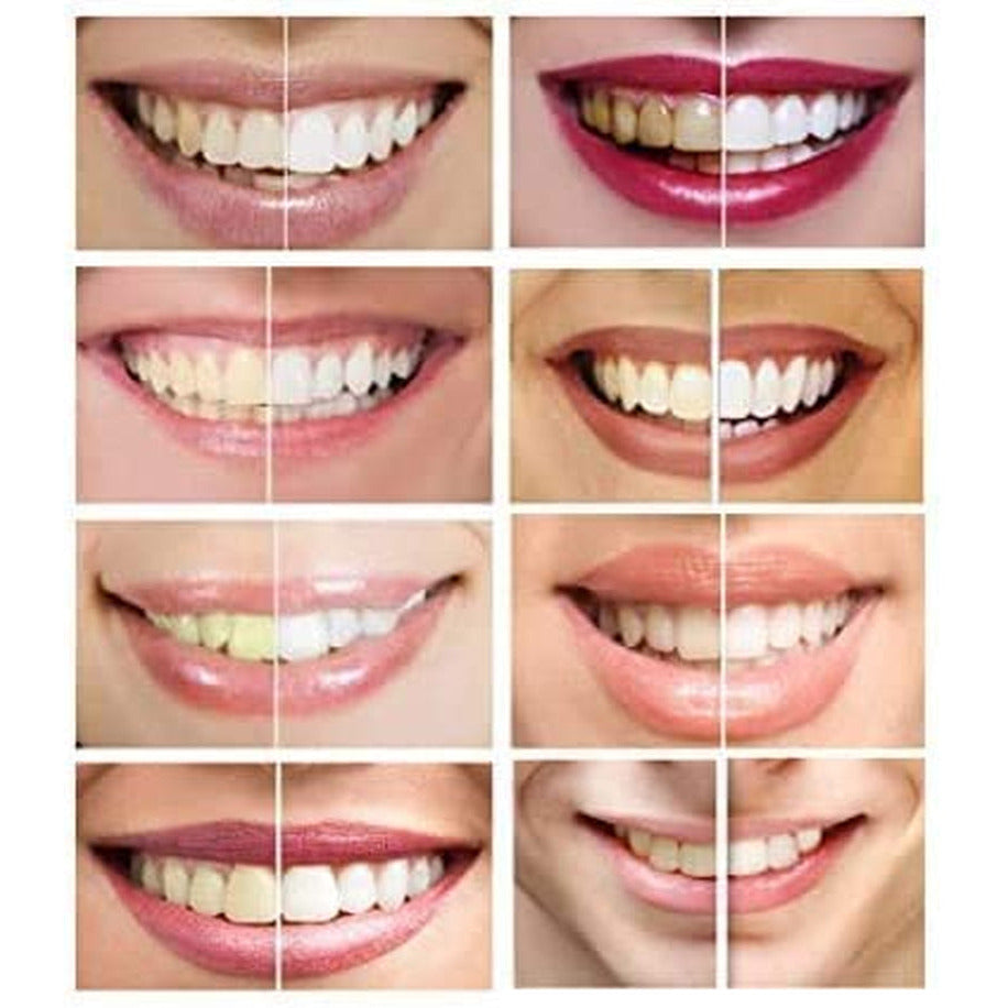 White Teeth Global Teeth Whitening Gel 44% Carbamide Peroxide, 6 Tooth Bleaching Gel Syringes